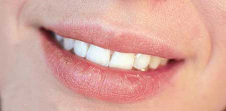 درمان های ساده و ارزان قیمت خانگی برای سفیدی دندان