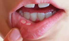 زخم های دهان نشانه چیست ؟