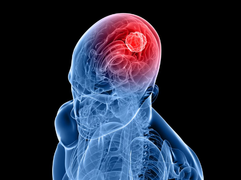 نشانه‌های اصلی تومور مغزی