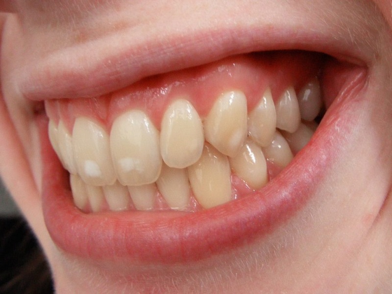 دلیل ایجاد لکه‌های سفید روی دندان/ راه درمان
